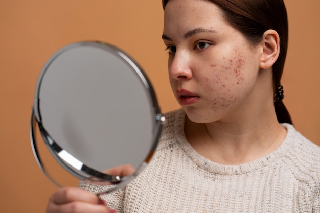 Does Paragard Cause Acne? Check Out the Facts!
