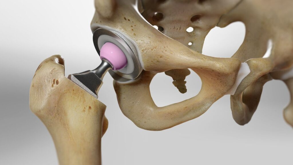 Unveiling The Journey of Wright Hip Replacement Lawsuit